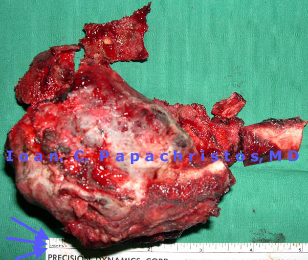 Specimen of the resected Giant Aneurysmal cyst of the right 8th rib