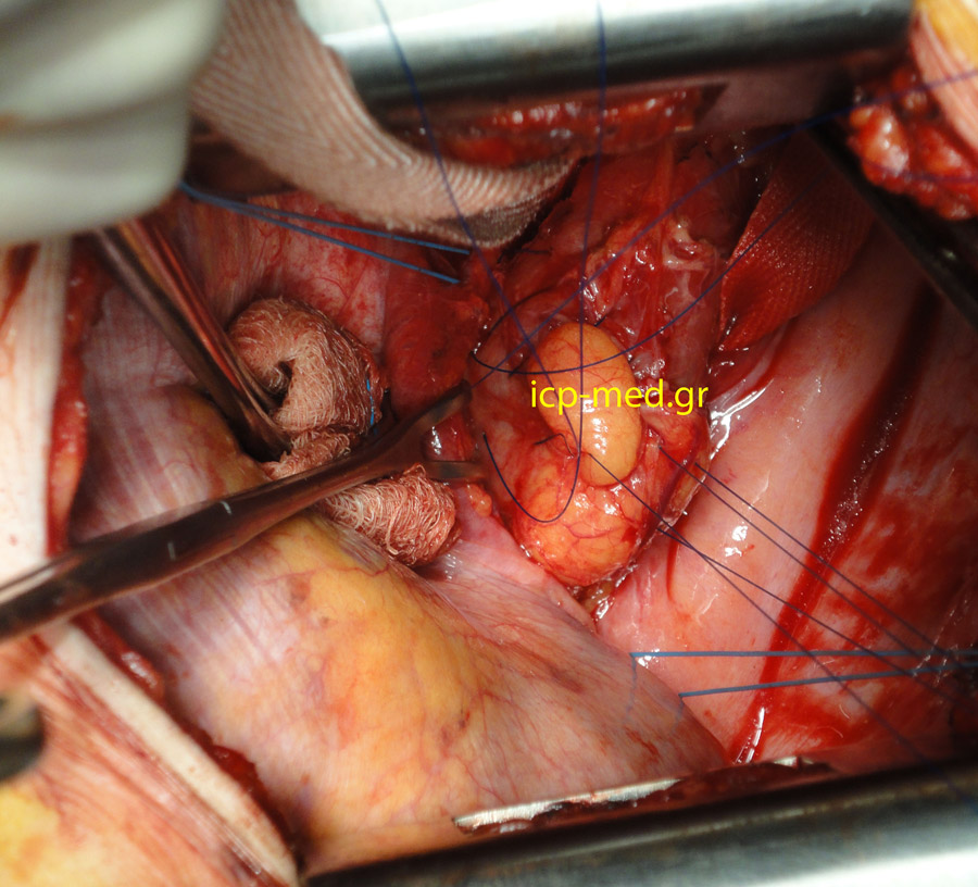 3. First Row of 4 sutures (still untied). Diaphragm held by instrument