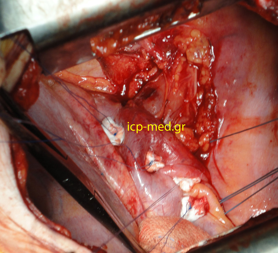 5. Second Row of 4 sutures tied, with the hiatal hernia reduced (fixed below) the diaphragm