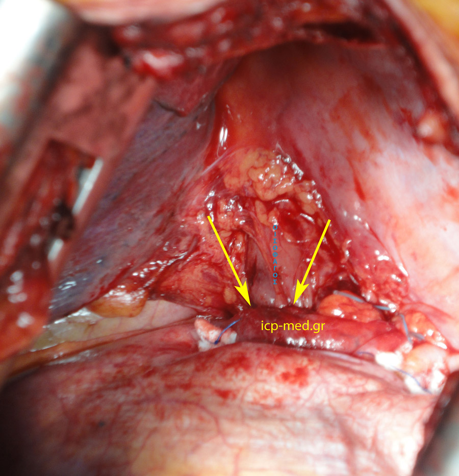 6. Complete Repair. YELLOW: the point where oesophagus is exiting the hemithorax towards the abdomen (no longer fundus in chest)