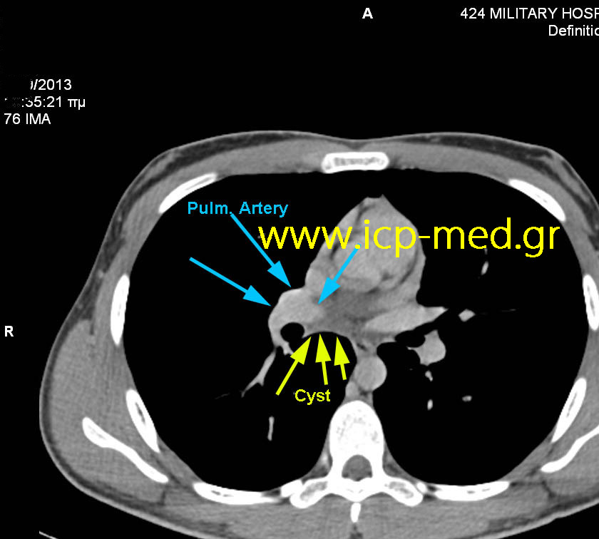 Preop CT: Cyst's close proximity to the right Pulm. artery (BLUE)
