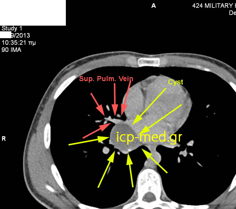 Preop CT: Cyst's close proximity to the superior Pulm. vein (RED)