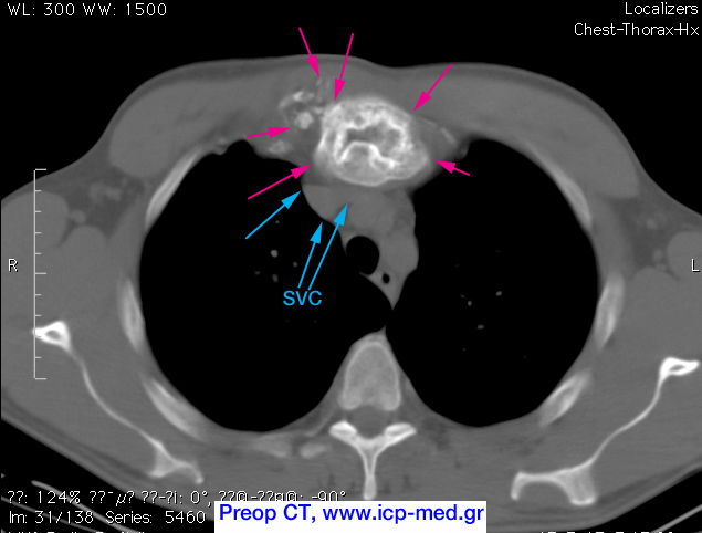 4. PreOp CT. The tumour (magenta arrows) abuts the Superior Vena Cava (cyan arrows)