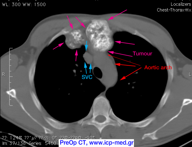 5. PreOp CT. The tumour (magenta arrows) abuts the aortic arch / ascending aorta (red arrows)