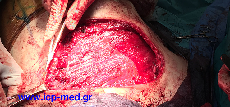10. IntraOp photo. A right latissimus dorsi flap is sewn, to cover the underlying complex reconstruction of the chest wall.