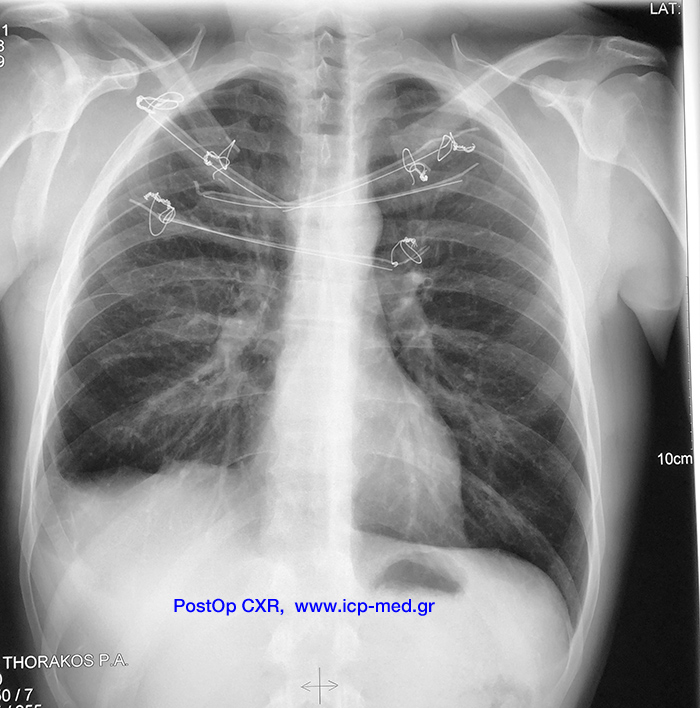 12. PostOp CXR (posteroanterior). Apparent methyl-methacrylate tubes, reinforced by steel wires at the anterior chest wall