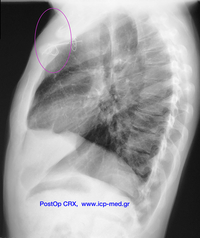 13. PostOp CXR (lateral). One can see the area of resection highlighted