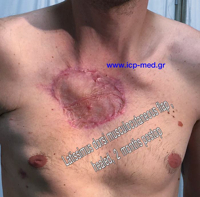 14. Appearance of the patient's anterior chest wall, fully healed.
