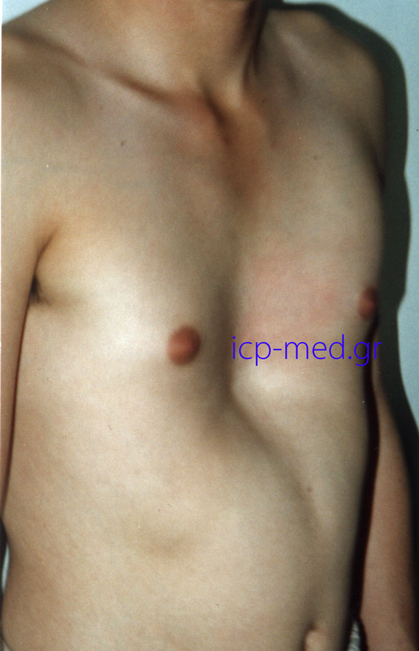 Deep depression at the lower part of sternum preoperatively