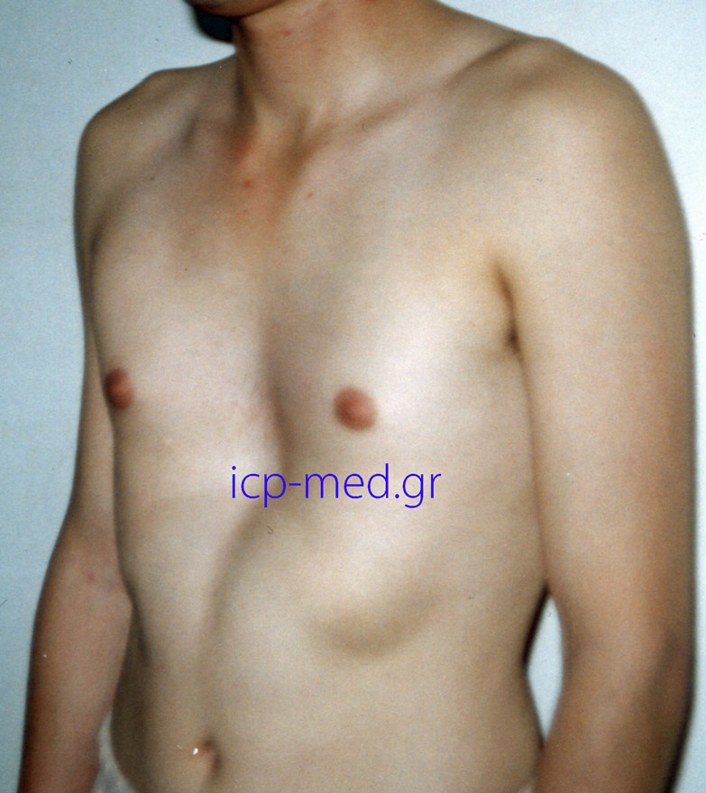 Deep depression at the lower part of sternum preoperatively