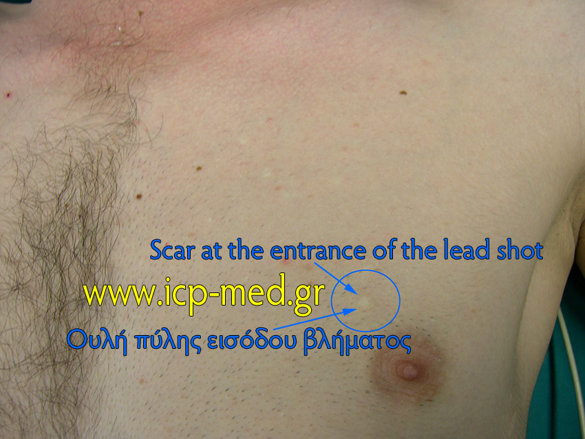 2. Scar of the entrance wound