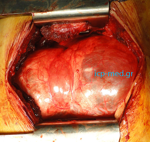 4. Large bulla deeply inside the pulmonary tissue