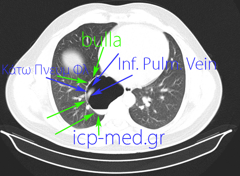 13. Preoperative CT. BLUE arrows: Inferior Pulmonary Vein. GREEN: the bulla