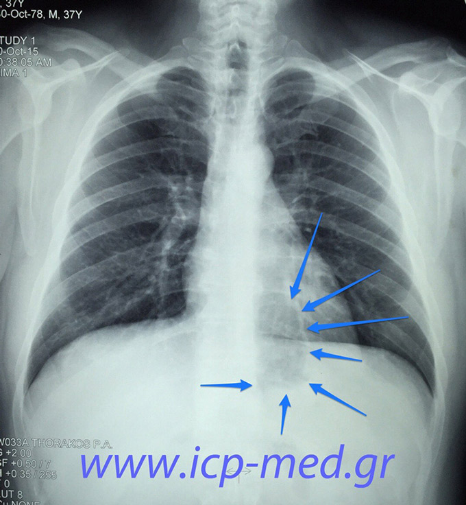2. The same preop CXR. Arrows: intrathoracic part of stomach, missed earlier by many 