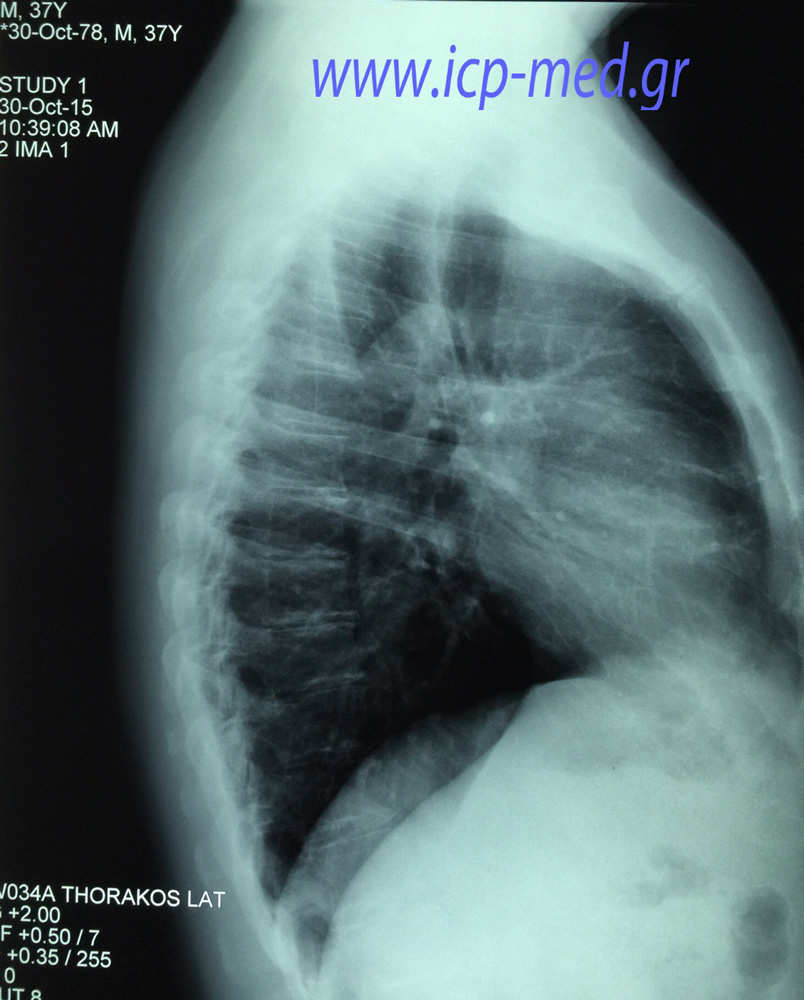 3. Posterolateral preop CXR of the same case, as above (images 1-2-3: same clinical case)