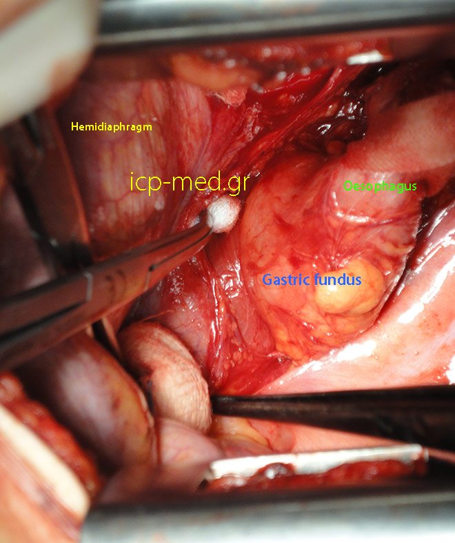 7. Intraoperatively the hiatal hernia aka the 'intrathoracic fundus of stomach' (BLUE). GREEN: oesophagus, YELLOW: diaphragm