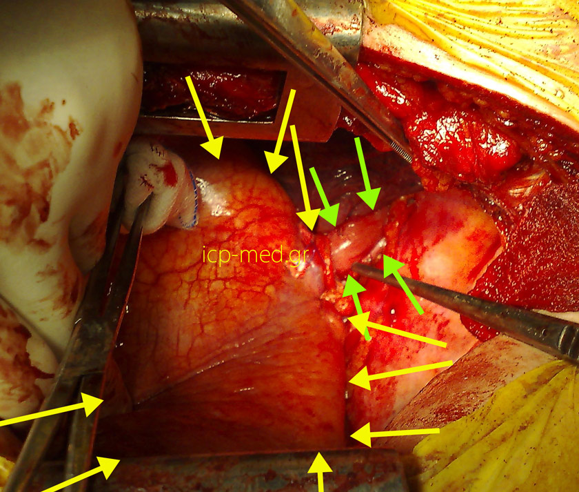 9. Intraoperatively Post repair: there is no longer any part of the stomach inside the chest (GREEN: oesophagus, YELLOW: diaphragm)