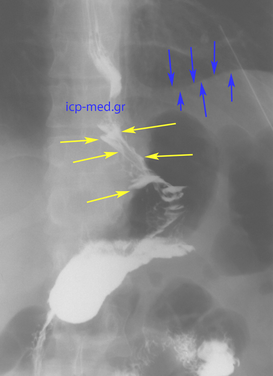 11. Postop radiologic image: there is no longer any intrathoracic stomach (BLUE: diaphragm, YELLOW: intraabdominal stomach)