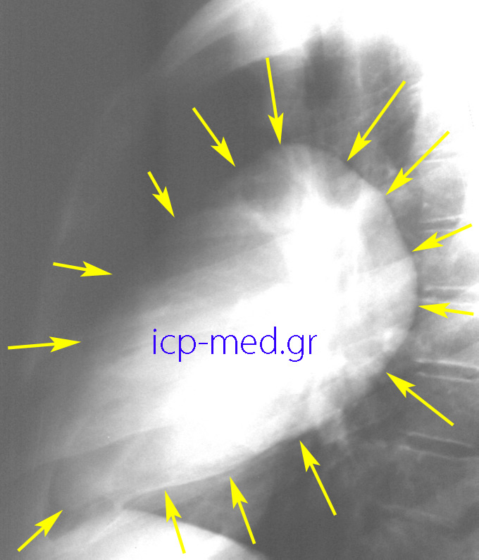 2. Preop CXR (lateral): Gigantic Hydatid Cyst (18 x 12 cm, YELLOW arrows) of the right lung