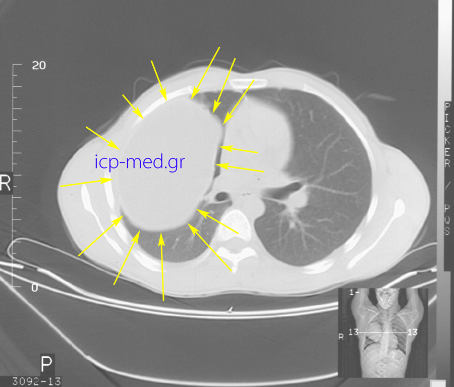 4. Preop CT: Gigantic Hydatid Cyst (18 x 12 cm, YELLOW arrows) of the right lung.