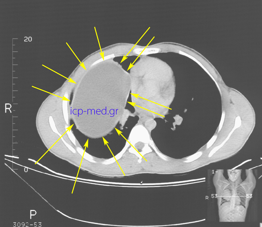6. Preop CT: Gigantic Hydatid Cyst (18 x 12 cm, YELLOW arrows) of the right lung, abutting the hilum vessels & the heart