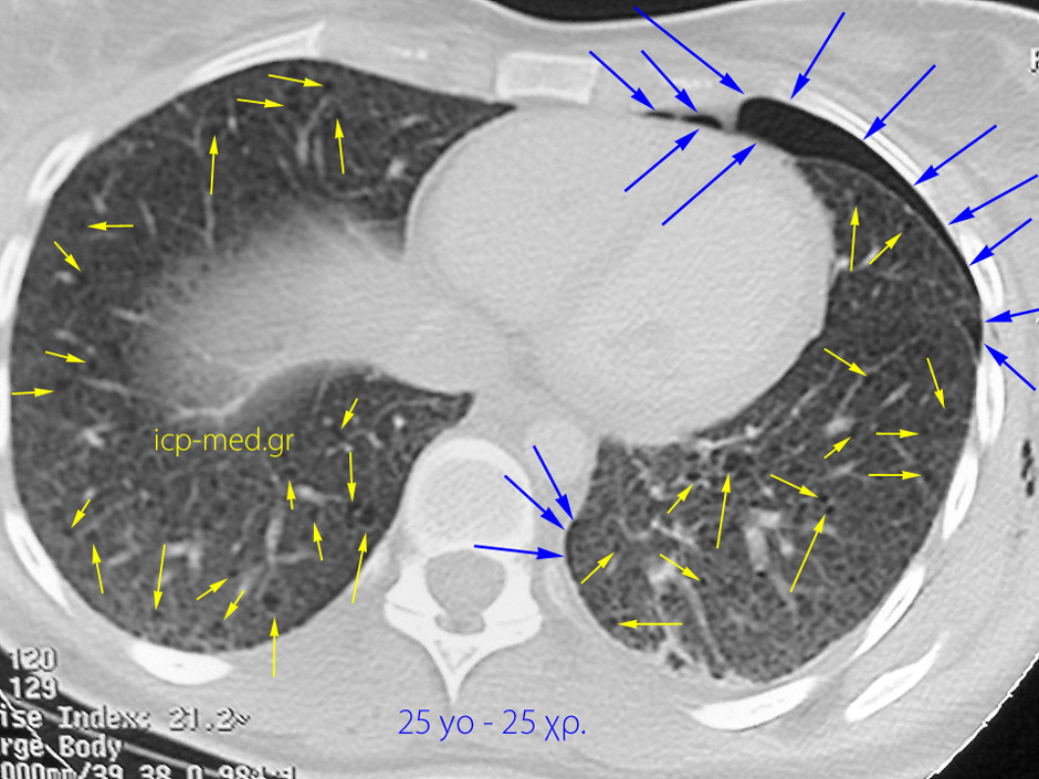 2. CT: thin-walled bullae, pneumothorax (left-sided) & surg. emphysema in a 25-yo ♀