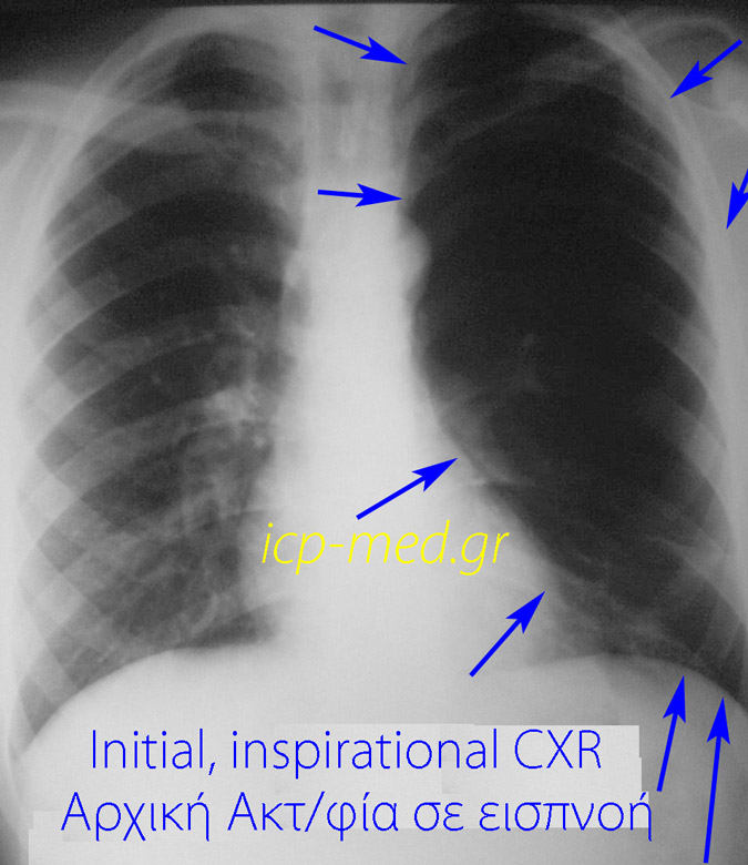 1. Initial CXR of Asymptomatic male subject with hyperlucent lung, left-sided
