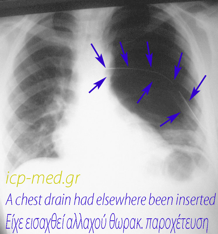 2. The non–apical chest drain, elsewhere inserted: post–procedural persistence of hyperlucency