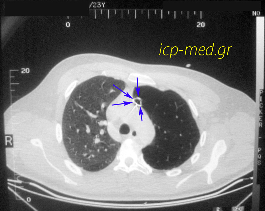 3. Chest CT: vascular desertion on the left side (left pulmonary artery stenosis) & Pneumothorax