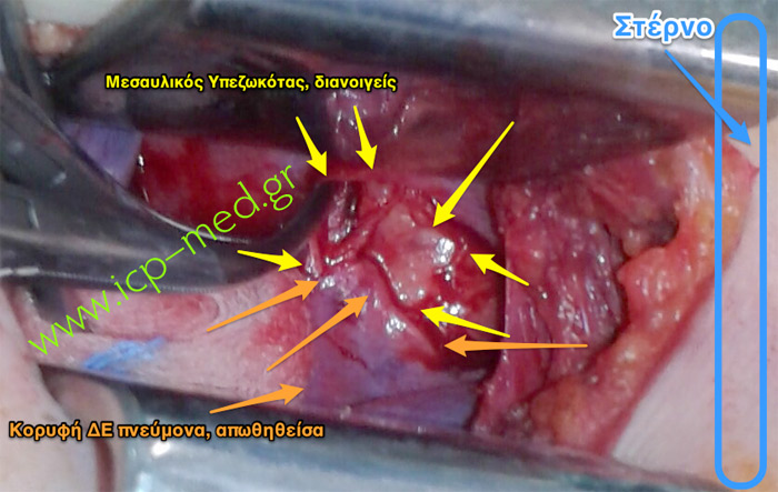 2. The apex of the lung (orange) is retracted backwards: the Mediastinum (yellow) gets exposed (it comes into view)
