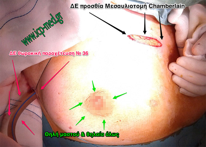 4. The incision of a right anterior mediastinotomy (black arrows) prior to closure