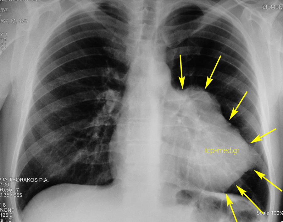 1.Preop CXR: YELLOW arrows point to the tumour (thymoma)