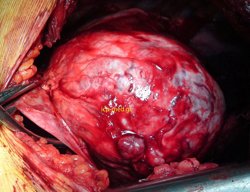 2.Thymoma, seen through left thoracotomy (bed of the 5th rib)