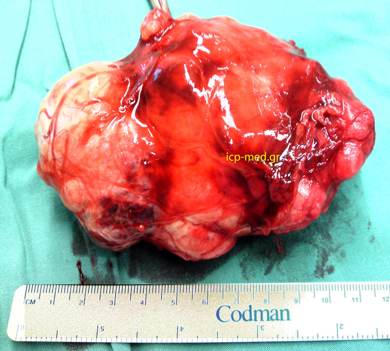 9.Specimen of Thymoma resected through median sternotomy