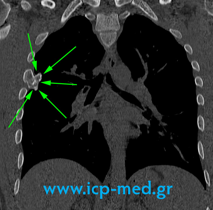 7. Preop MRI (coronal view)