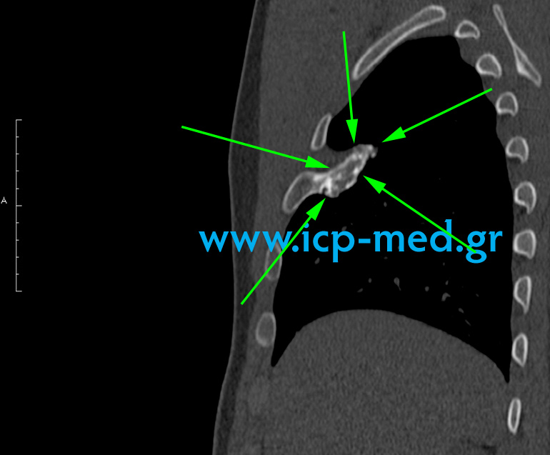9. Preop MRI (sagittal view)