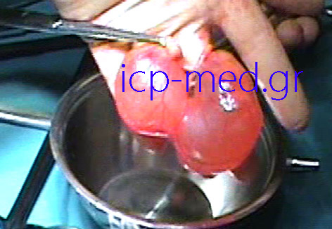 5.The very same specimen as previous image (two confluent pericardial cysts)