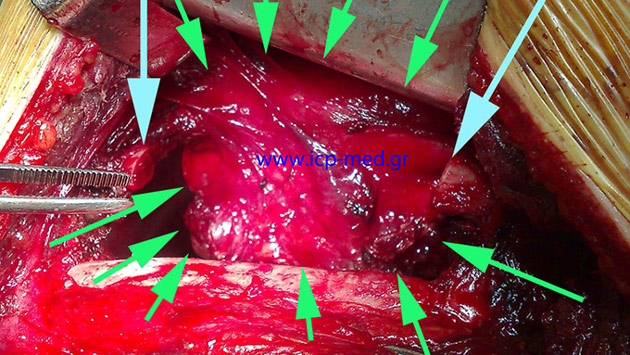 Green: Tumour still inside the surgical field, White: the transected 5th rib