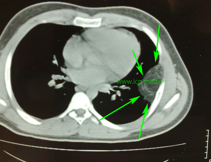 Preop CT. Green: atypical lipomatous tumour of the 5th left rib