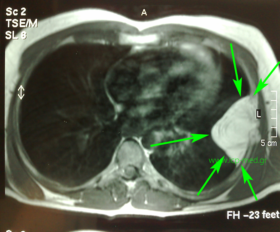 Preop MRI. Green arrows: tumour