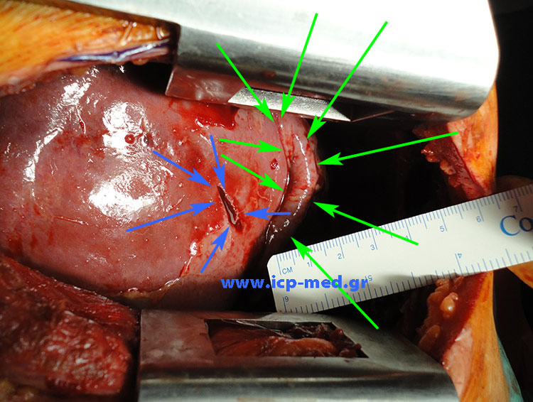 GREEN: Ruptured Right hemidiaphragm. BLUE: Liver Laceration