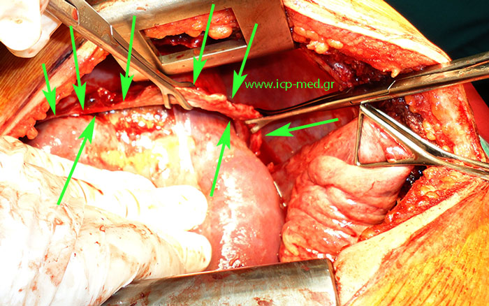 GREEN arrows: rupture of the right hemidiaphragm