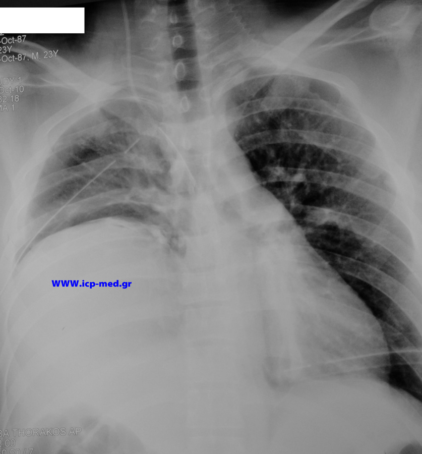 Preop CXR: marked elevation of the right hemidiaphragm