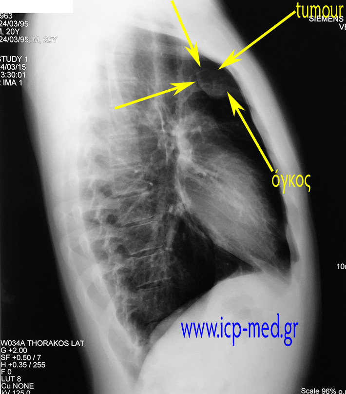 2. Preop CXR (lateral) upon admission
