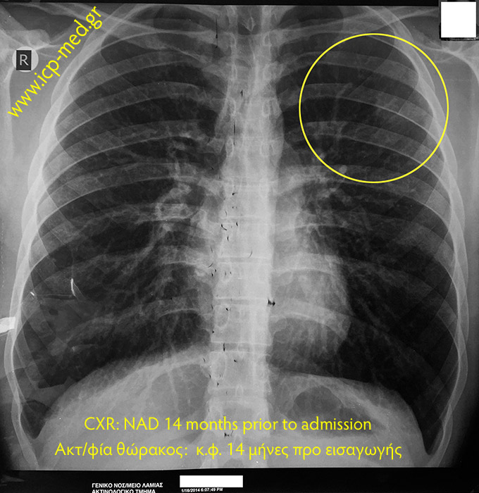 3. No abnormality detected on CXR 14 months prior to admission