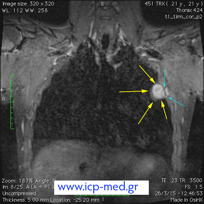 6.  Preop MRI scan (coronal view; cyan arrows: the contact between the tumour & the 3rd rib)