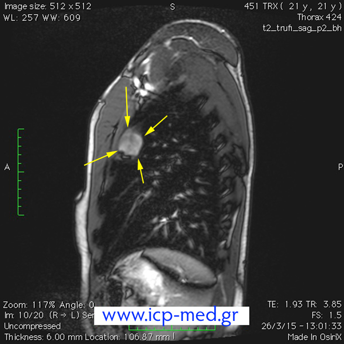 8. Preop MRI scan (sagittal view)