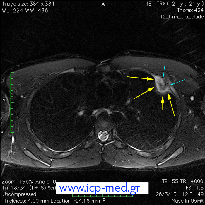 9. Preop MRI scan (axial view; cyan arrows: the contact between the tumour & the 3rd rib)