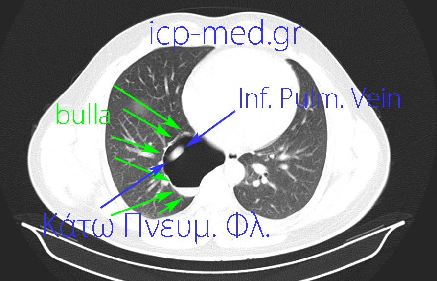 15. Προεγχειρητική CT: ΜΠΛΕ βέλη: η Κάτω Πνευμονική Φλέβα. ΠΡΑΣΙΝΑ: η αερώδης κύστη