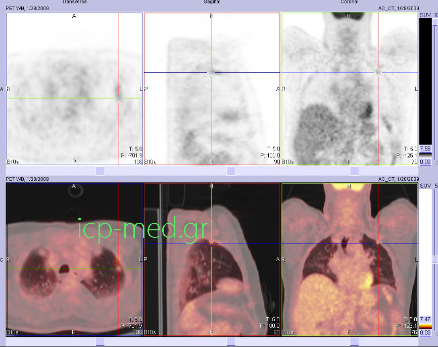 7. Προεγχειρητική PET/CT (Ποζιτρονική Τομογραφία συνδυασμένη με CT) 72-χρονου καπνιστή με Μάζα στον ΑΡ πνεύμονα